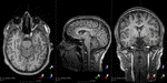 MRI Motion Artefacts Simulation and Correction using Complex-Valued Deep Learning